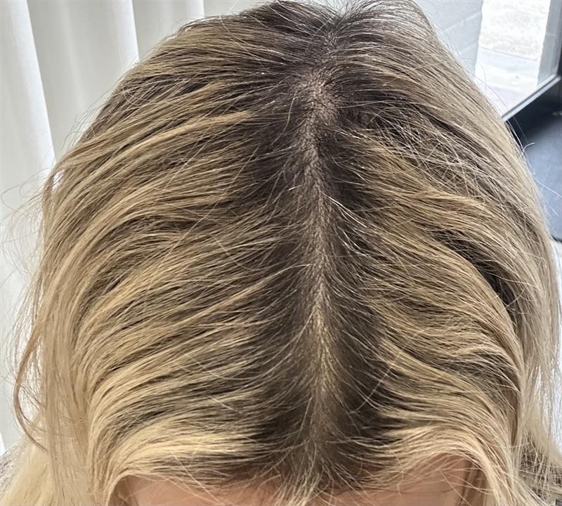 Female hair regrowth results with IntoGlowra red light therapy hair growth hat and cap